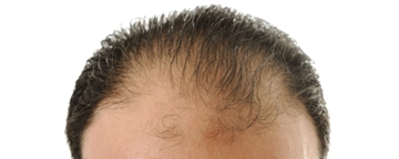 Çinko Eksikliği Saç Dökülmesi Çinko Eksikliği Saç Dökülmesi